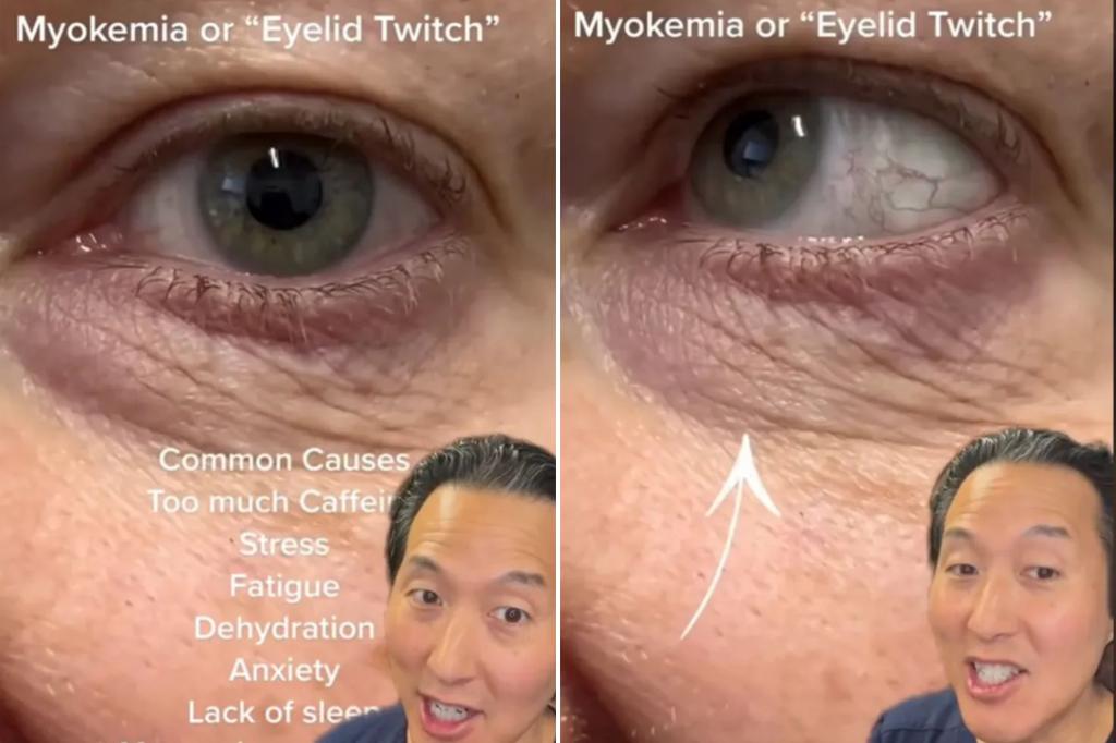 I'm a doctor - here are 3 ways to stop eyelid twitching